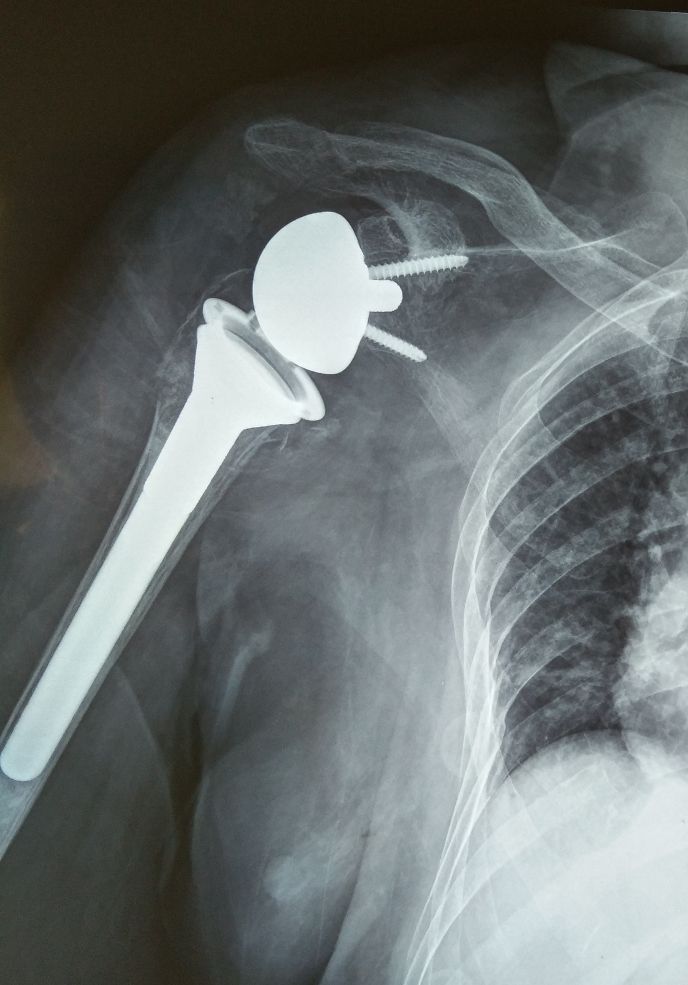 病例分享：不论什么疾病，只要有功能问题，就需要规范化康复治疗