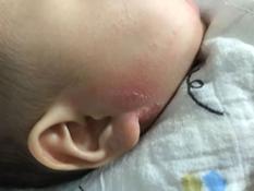 宝宝湿疹严重妈妈吃什么食疗,湿疹的分类及应对方法