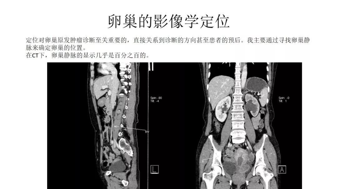 卵巢原发肿瘤的分析思路
