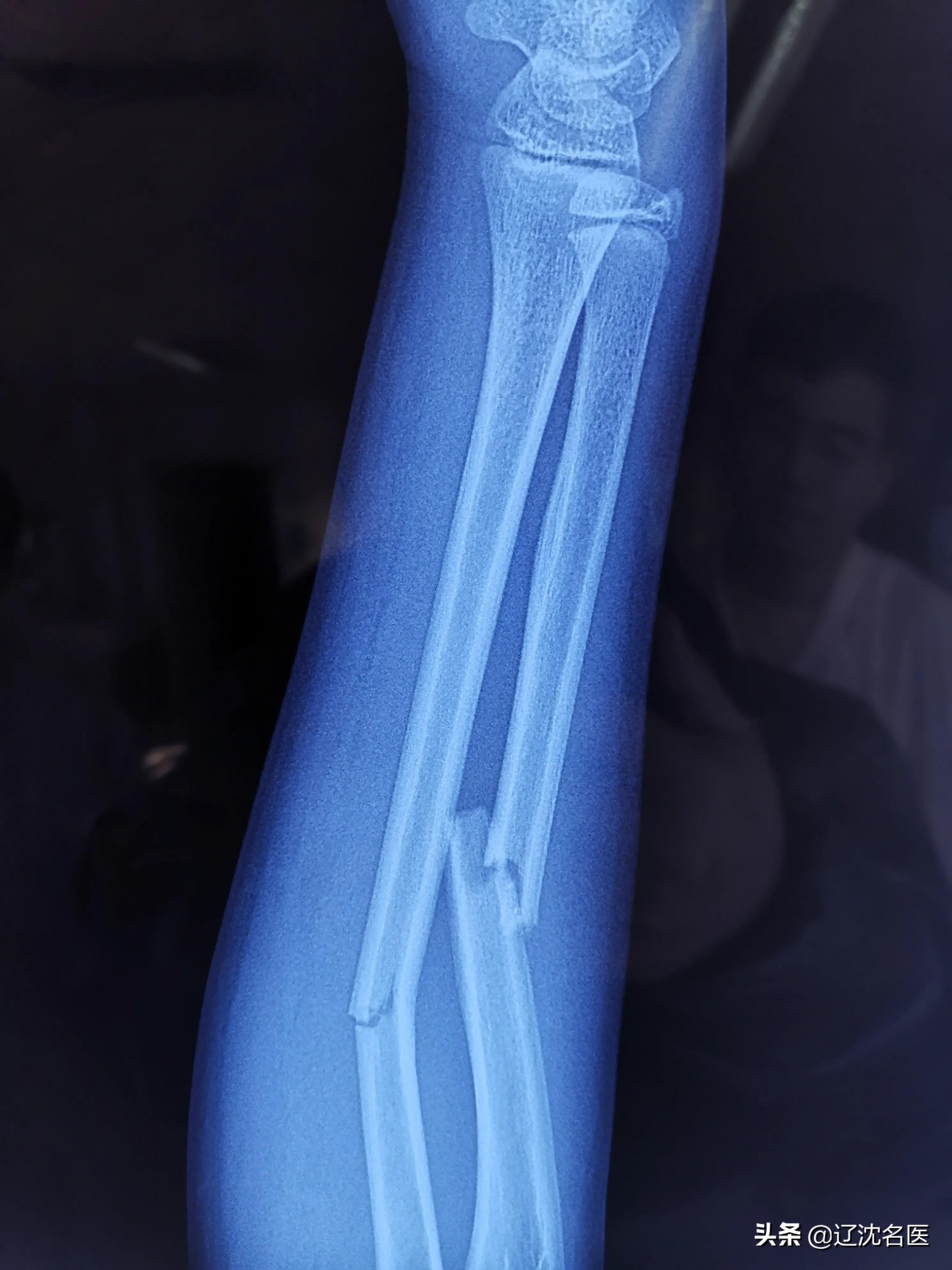 儿童尺桡骨双骨折保守治疗后错位,六岁儿童桡骨颈骨骨折多久恢复