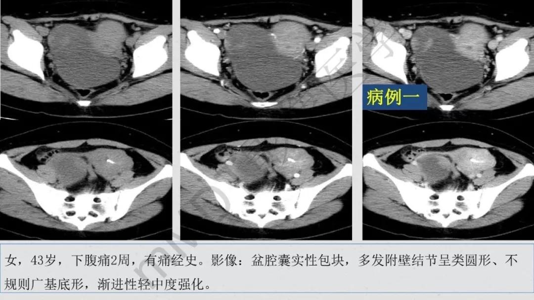 卵巢原发肿瘤的分析思路