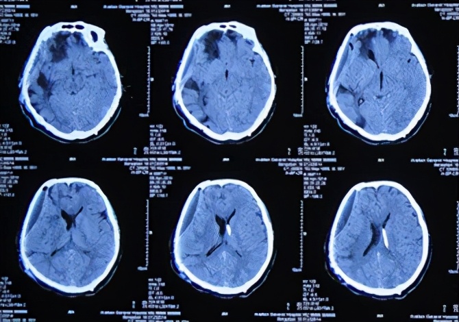 脑外伤开颅手术后脑积水,脑外伤手术后脑脊液鼻漏怎么治疗