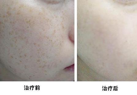 产妇脸上干燥起皮有红点怎么办,生完孩子脸上有褐斑怎么消除