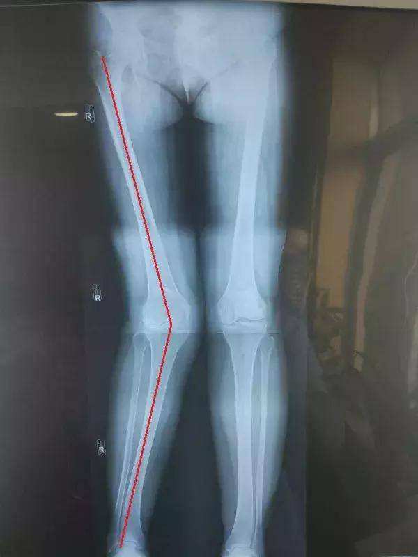 膝内翻与膝外翻的区别儿童,3岁小孩膝外翻常见吗需要治疗吗