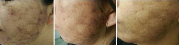 不同痘坑凹洞擦什么药膏,不同痘坑怎么修复