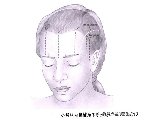 内窥镜提眉和手术提眉哪个好,提眉术和切眉手术哪个简单