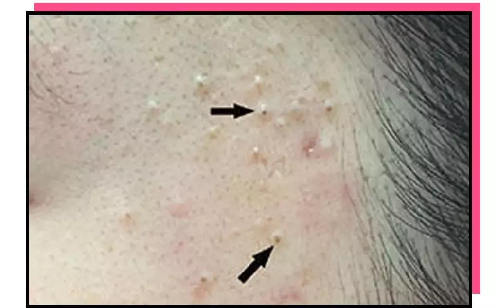 痘肌调理真实案例,痘肌10年了怎么修复