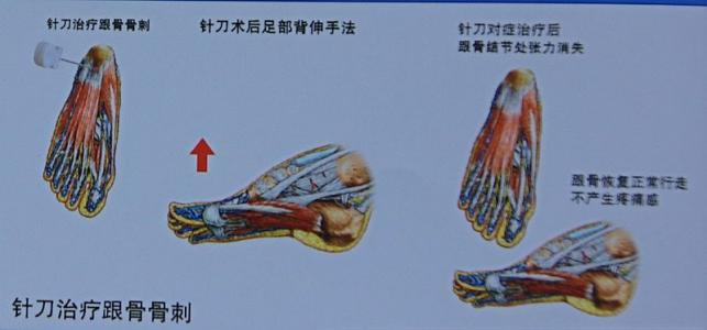 足跟痛应该怎么治疗最好,足跟痛怎么治呢