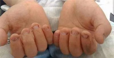 小孩啃指甲对不对,孩子啃指甲吃手指是怎么了