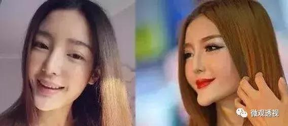 整容在韩国有多普遍,韩国整容贵还是国内整容贵