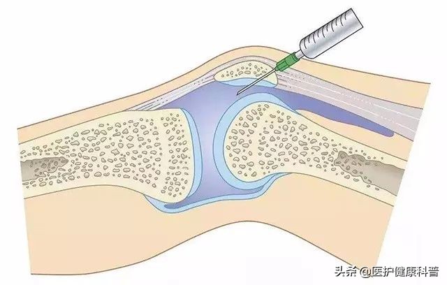膝盖反复肿是怎么回事,膝盖滑膜炎肿了应该如何按摩