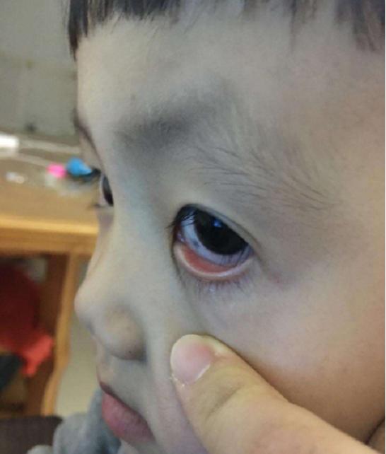 孩子眼睛眼白处有灰黑点,孩子眼睛眼白有黑斑咋回事