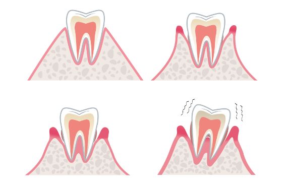 牙齿黑三角怎么补救,牙齿上的黑三角怎么改善
