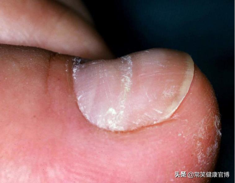 指甲出现各种问题的图片,指甲出现这些症状可能是灰指甲