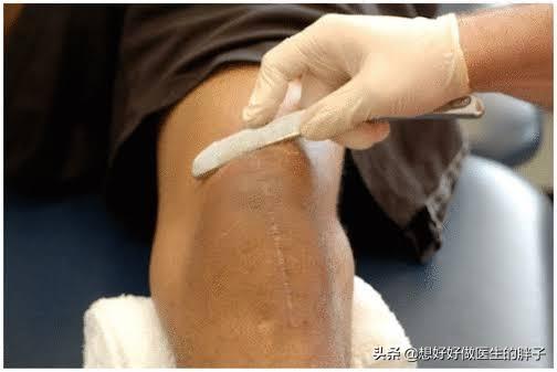 骨折膝关节粘连到哪里康复好,骨折后膝关节粘连怎么锻炼