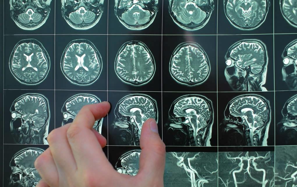 腔梗和腔隙性脑梗有什么区别,腔隙性的脑梗是什么原因造成的