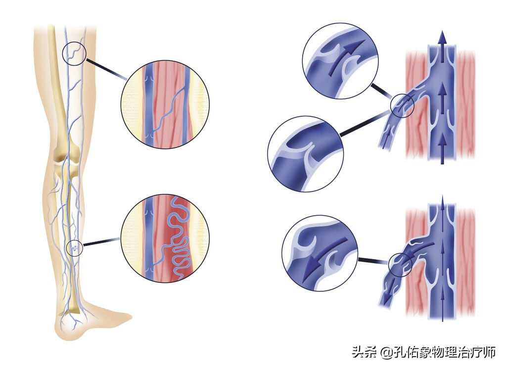 腿上细血管像蜘蛛样怎么回事,小腿上的血管像小蚯蚓一样