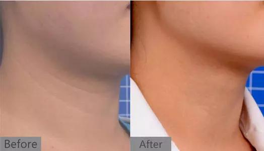 去脖子黑色素颈纹的最快方法,老年人脖子上的颈纹怎么遮挡