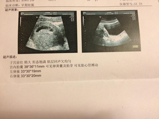 试管8周无胎芽胎心能要吗,8周未见胎心管搏动有救吗