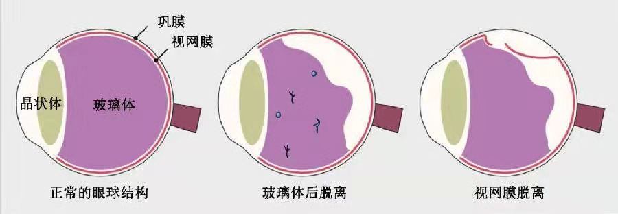 眼球晶体破洞,眼球裂缝是什么原因造成的