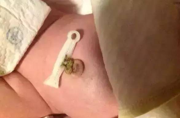 新生儿各种肚脐,新生儿肚脐容易出现的问题