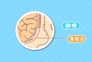 宝宝得脐疝一般多久能好,成人脐疝4-5公分用做手术吗