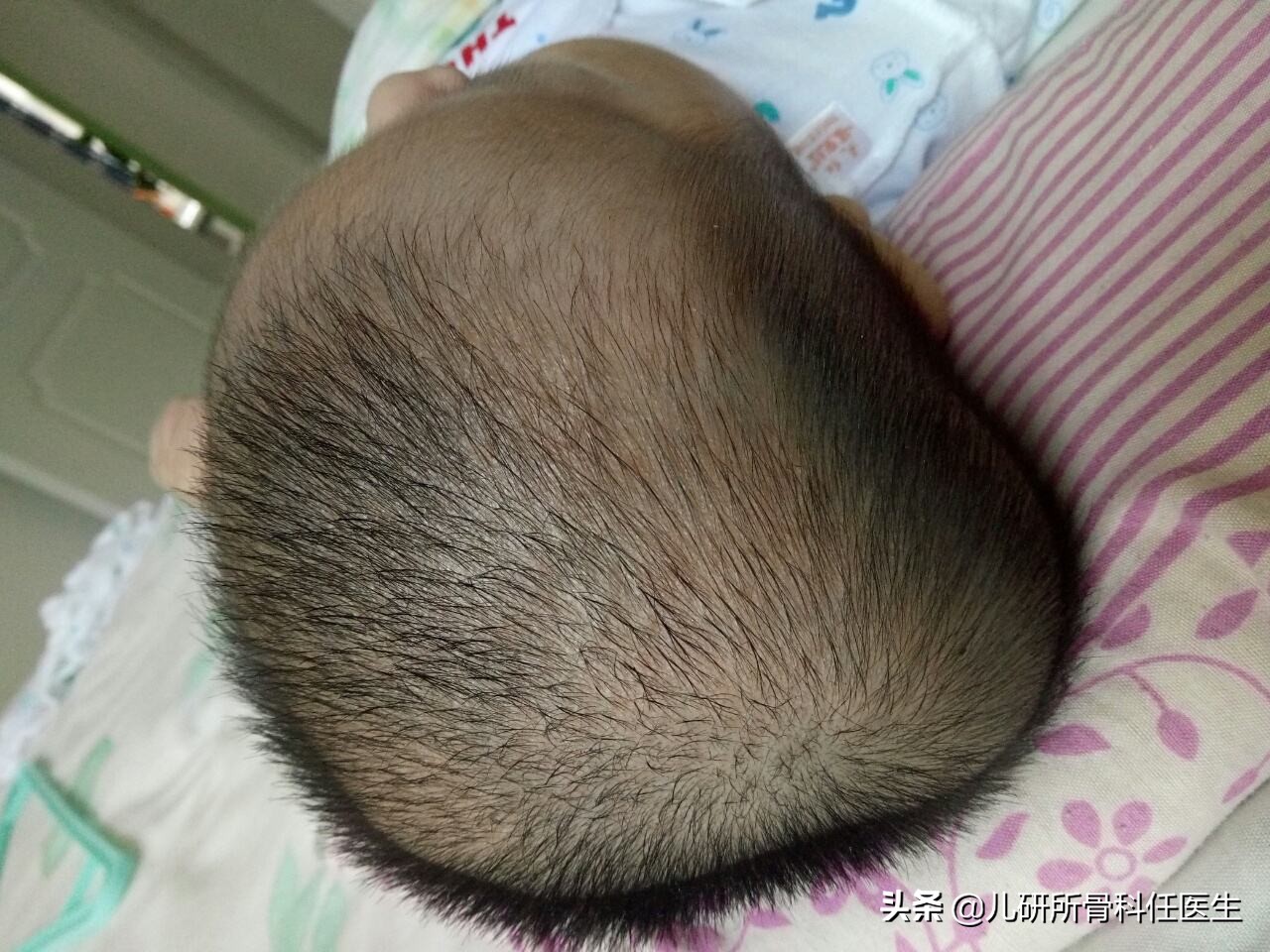 习惯性斜颈用颈托能矫正吗,习惯性斜颈治得好吗