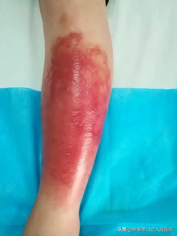 小腿又红又肿又痛还烫,小腿又红又肿