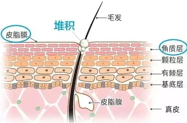 闭口怎么才能有效清理,闭口怎么处理最有效