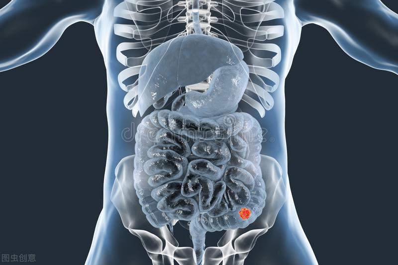 直肠管状腺瘤严重吗属癌吗,直肠管状腺瘤低级别