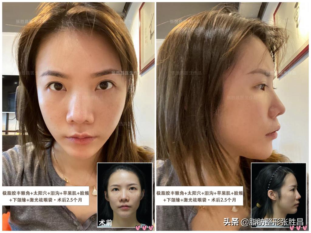 为什么脂肪填充要全麻,为什么脂肪填充算是整容