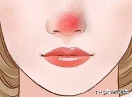 玫瑰痤疮酒糟鼻涂抹什么药,玫瑰痤疮别名酒糟鼻怎么治疗