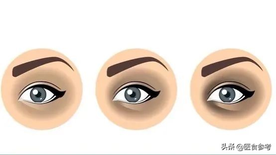 让张文宏“一直没有想明白”的黑眼圈问题，大概是这样的