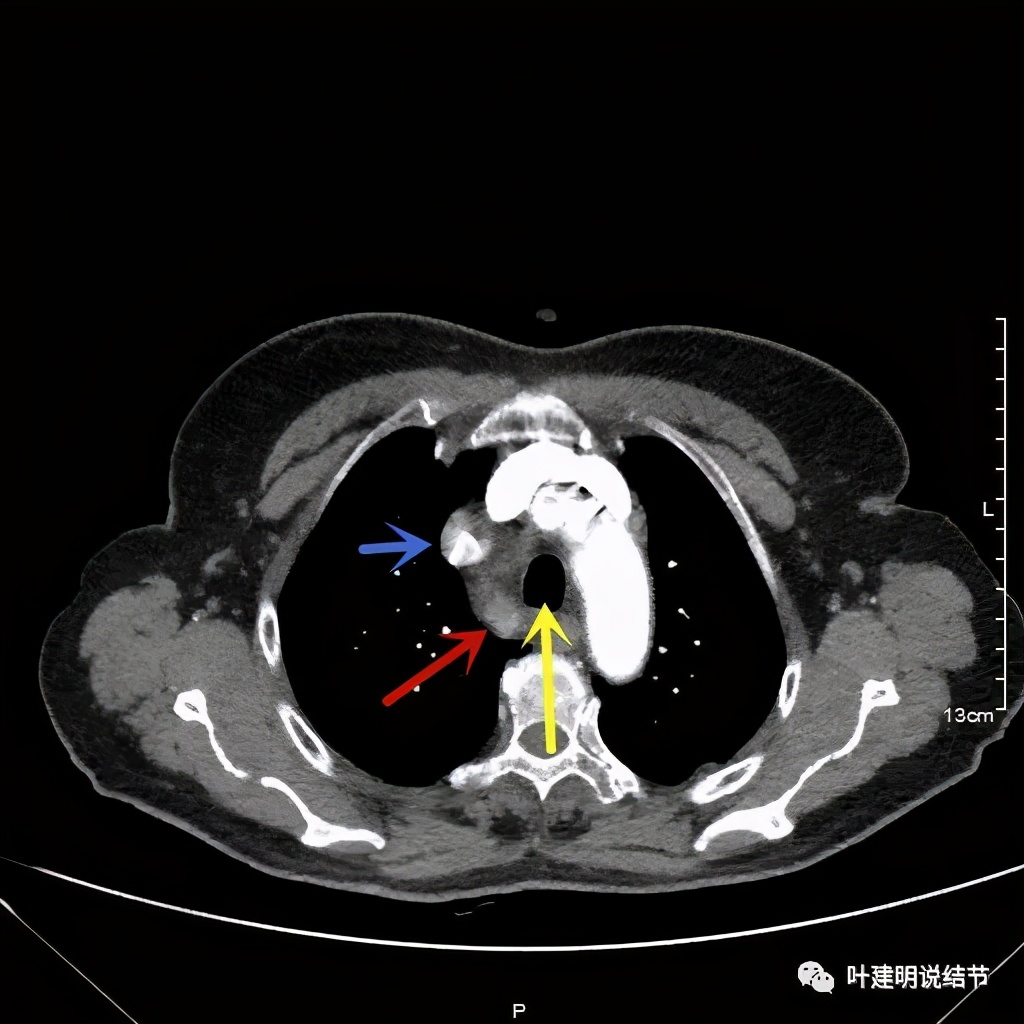 胸部高分辨ct检查注意事项,胸部ct扫描有没有危害