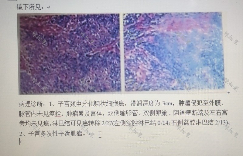 绝经后出血发现是子宫内膜癌,绝经几年了下身出血是宫颈癌吗