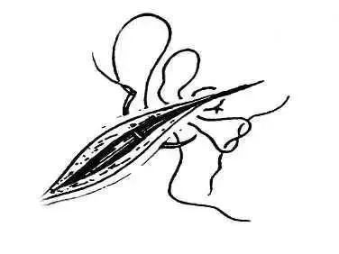 外科8种缝合方法图解,外科基本缝合方法实验报告