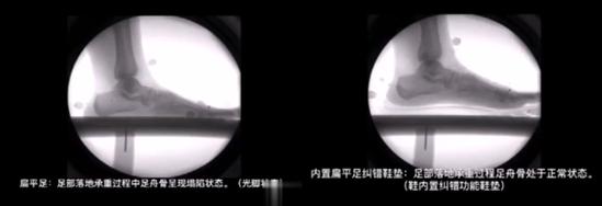 矫正鞋垫定制和成品的区别,矫正鞋垫定制方法