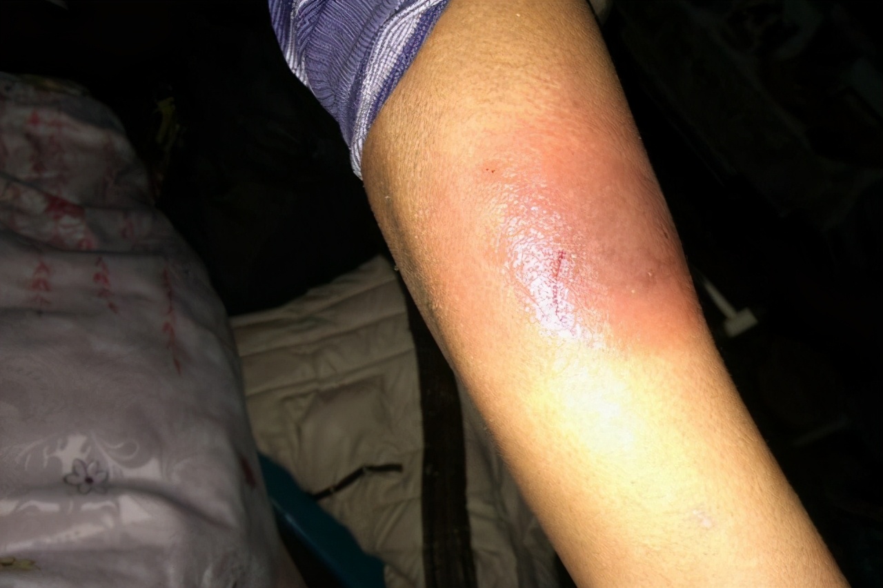 蚊虫叮咬教您几招止痒简单又快速,蚊虫叮咬怎么止痒最快最有效