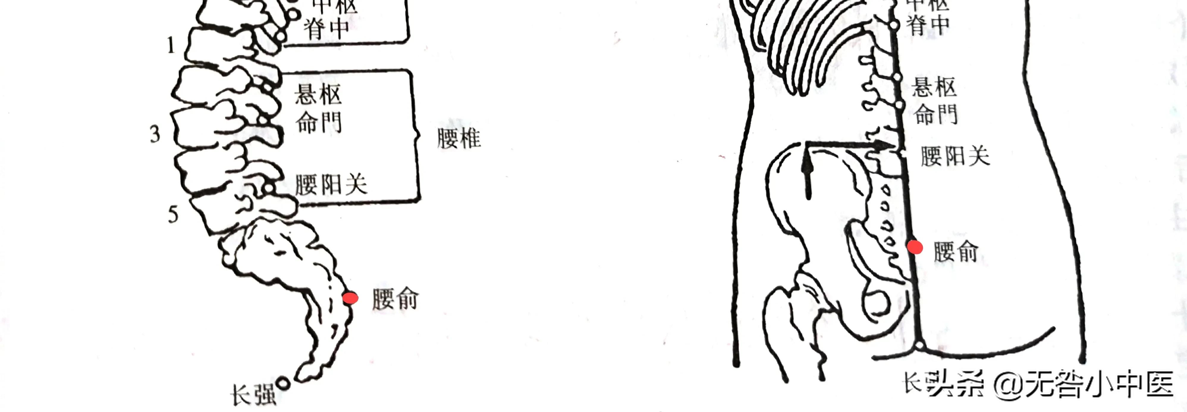 针灸腰部三根大针,针灸治疗腰突三周了