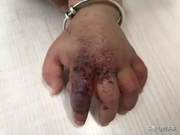 小朋友手受伤了肿的像馒头,孩子手肿得像包子