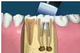 为什么修复牙齿始终要找一个大夫,为什么牙齿需要做根管治疗