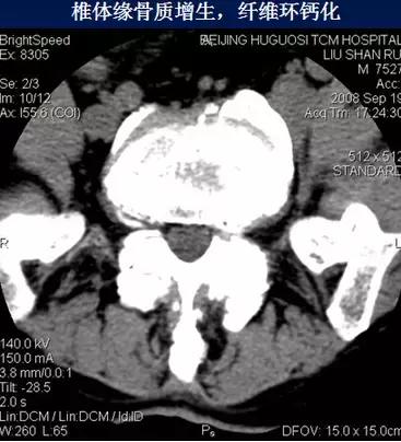 腰椎退行性变腰椎间盘轻度突出,椎间盘突出并膨出继发椎管狭窄