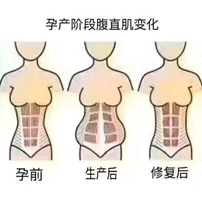 产后多久是腹直肌修复的最佳时间,产后腹直肌修复什么时候能做
