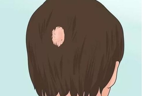 治疗斑秃脱发的药物,六种用于斑秃的药物