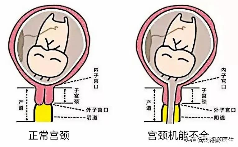 胎膜早破出血保胎成功案例,免疫问题会导致胎膜早破吗