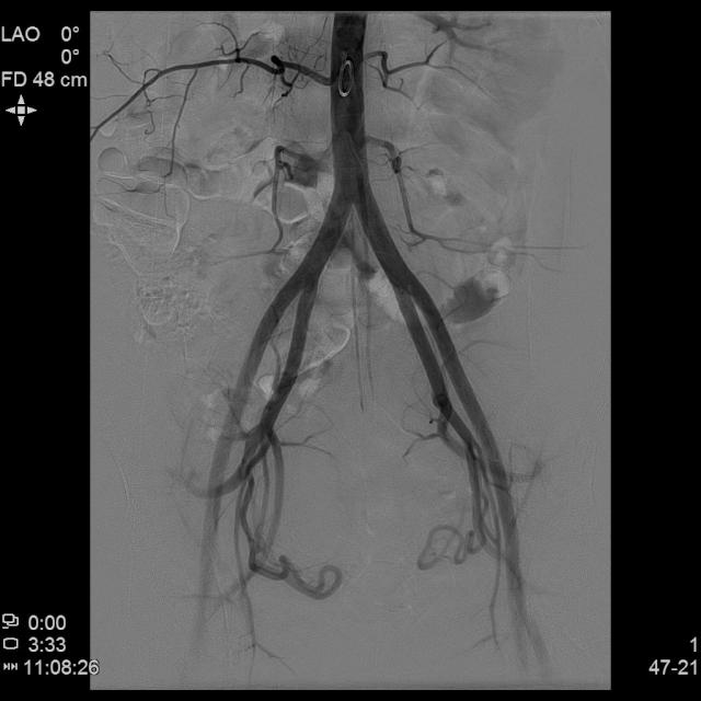 微创治疗前列腺增生的效果如何,远离前列腺