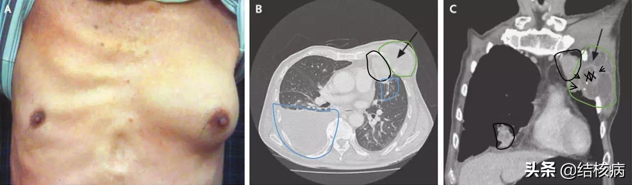 结核病的各种合并症和并发症,结核病有哪些并发症