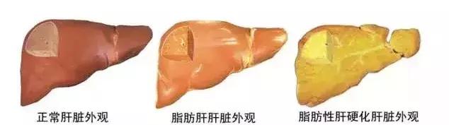 重度脂肪肝为啥医生说没啥问题,重度脂肪肝是不是严重了