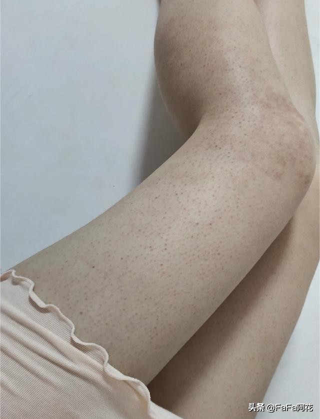 孩子腿上鸡皮肤怎么消除,腿上经常起红疙瘩鸡皮肤