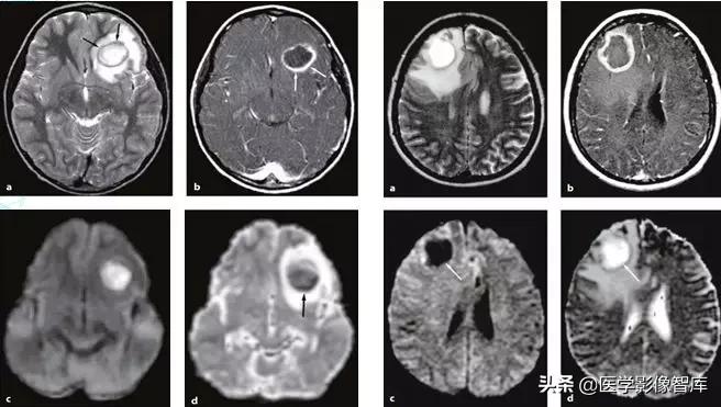 双侧额叶皮层区dwi偏高是什么意思,颅内dwi高信号病变